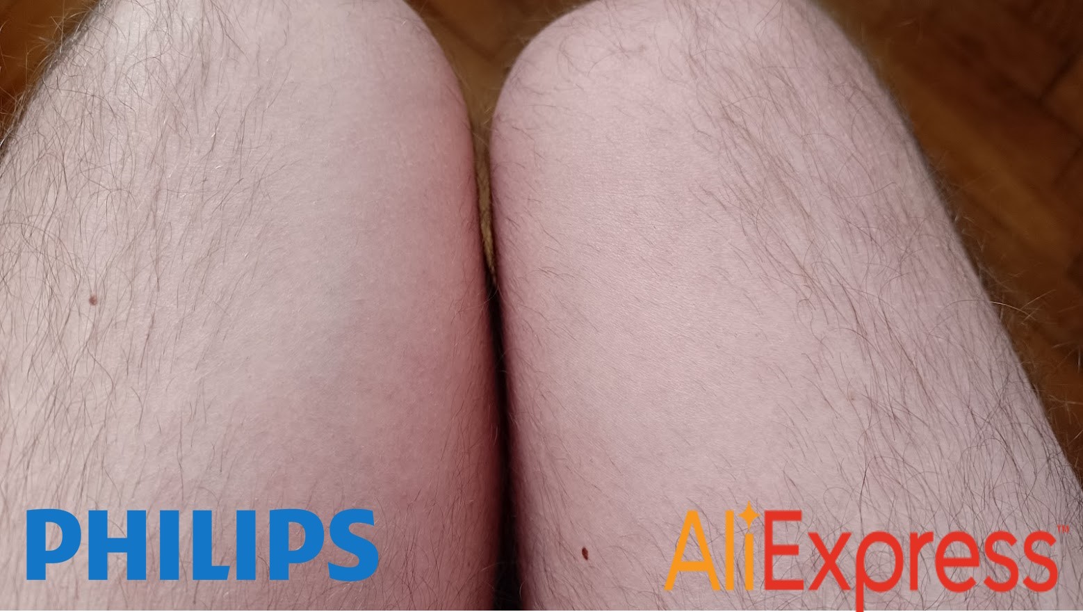 Porovnanie výsledkov IPL epilácie po 10 týždňoch vpravo Philips Lumea (bez chĺpkov), vľavo KODO (redšie chĺpky).